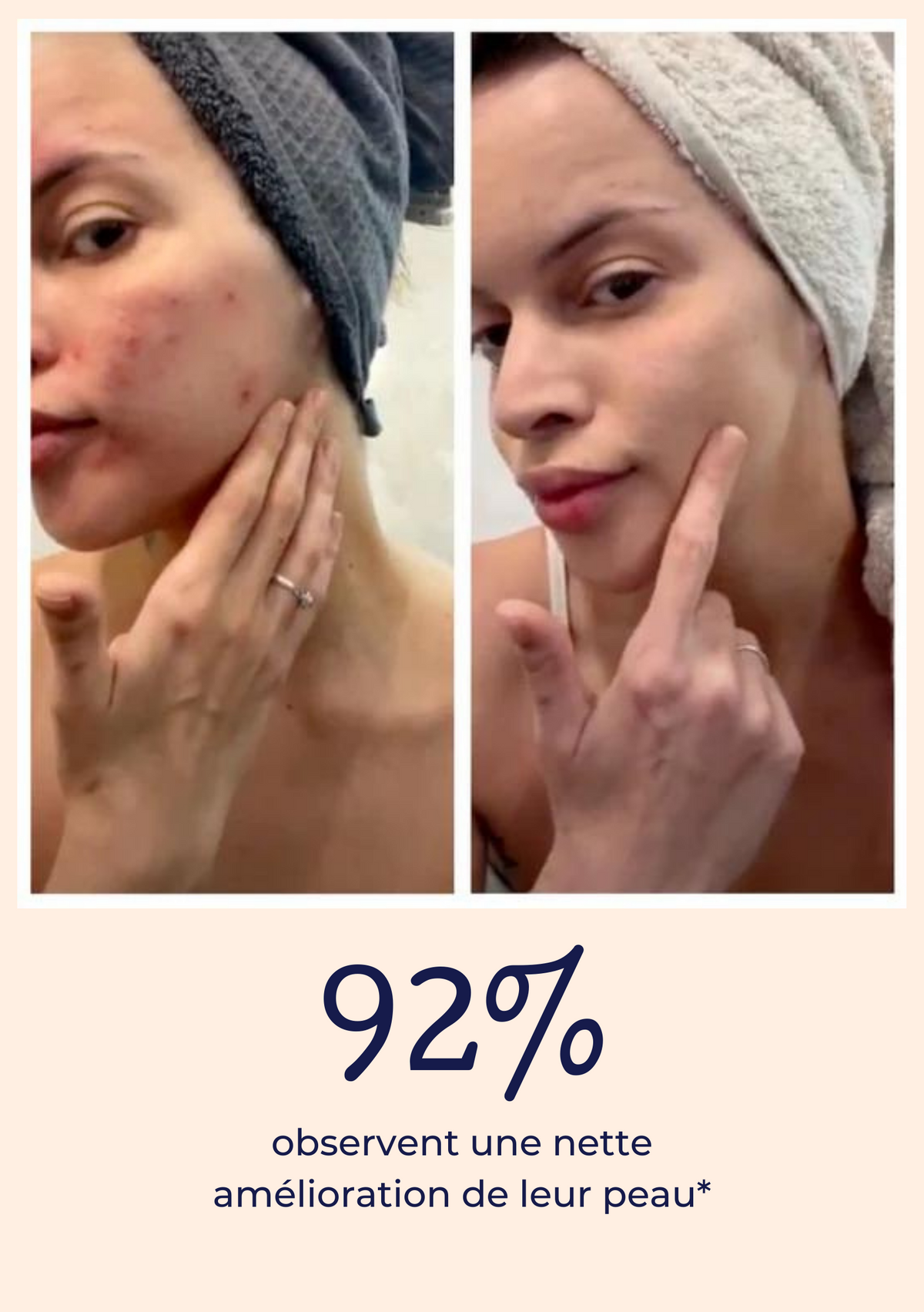 Comparaison avant et après utilisation d’un baume de nuit réparateur montrant une nette amélioration de l’apparence de la peau avec une réduction visible des rougeurs et imperfections.