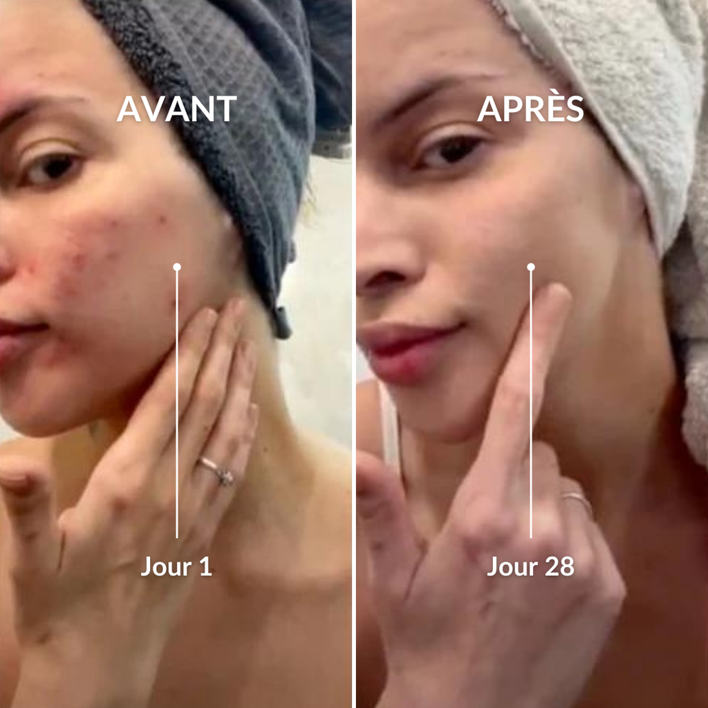Comparaison avant et après 28 jours d'utilisation montrant une amélioration visible de l'état de la peau avec réduction des rougeurs et imperfections sur un visage féminin.